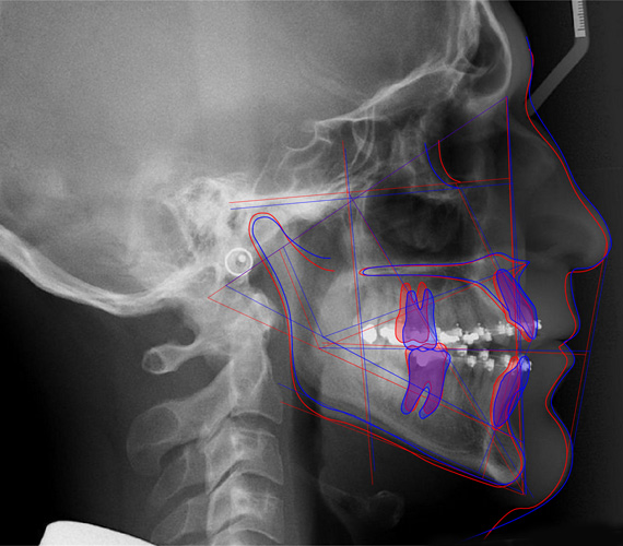 Planmeca Romexis cephalometric analysis superimpositions