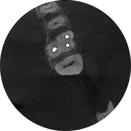 Endodontic imaging mode with ARA