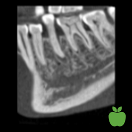 Low dose image with ultra low dose